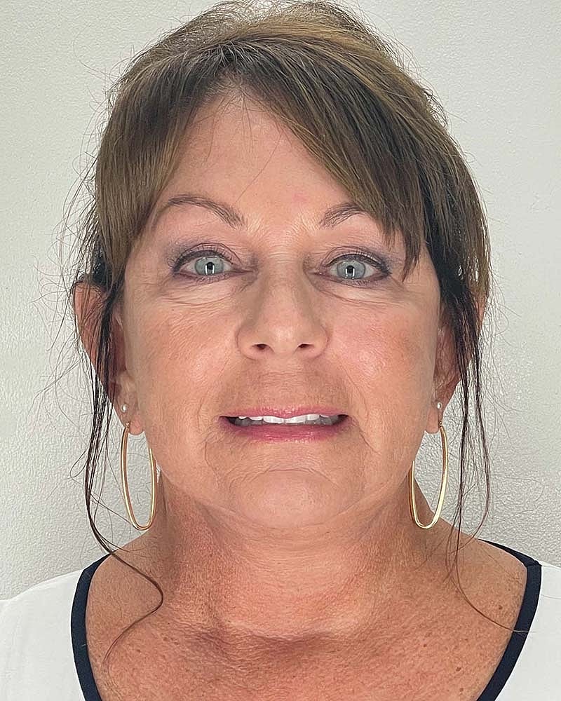 Facelift Before & After