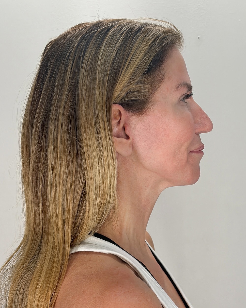 Facelift Gallery Before & After