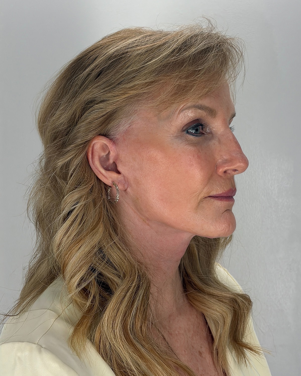 Facelift Gallery Before & After