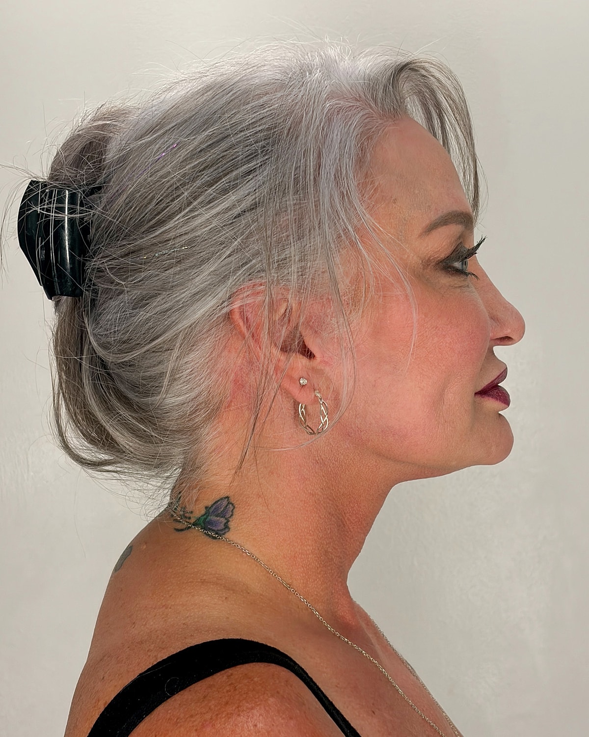 Facelift Gallery Before & After