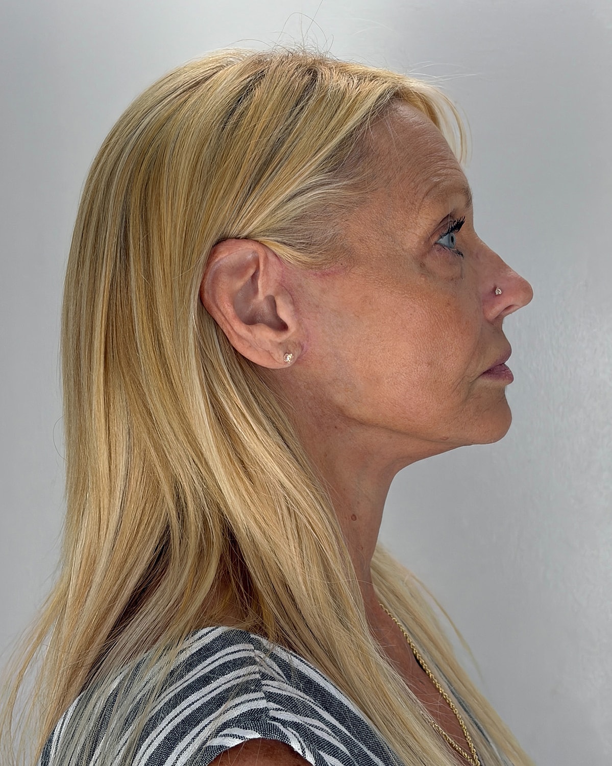 Facelift Gallery Before & After