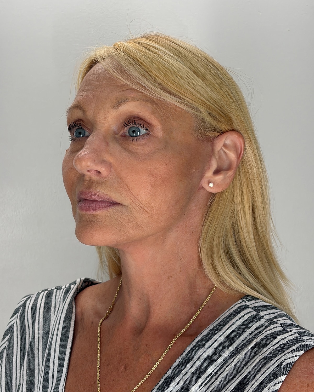 Facelift Gallery Before & After