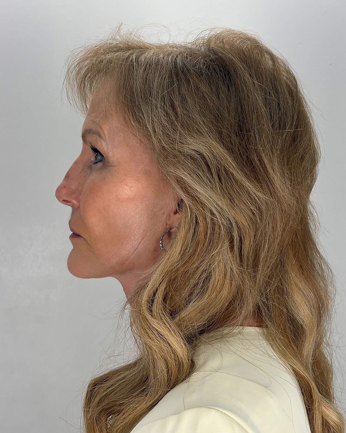Facelift Gallery Before & After