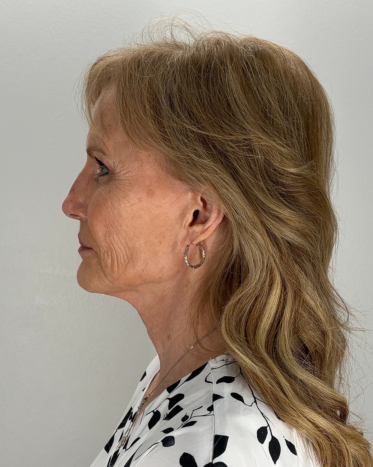 Facelift Gallery Before & After