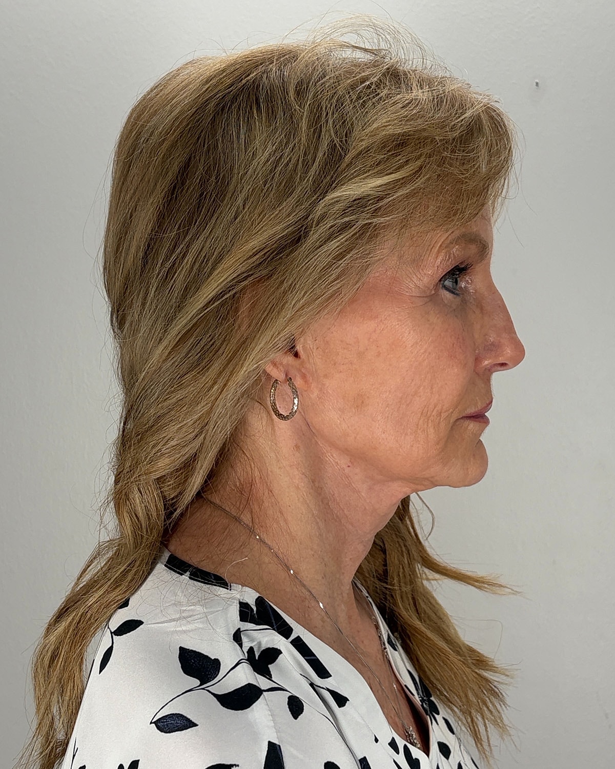 Facelift Gallery Before & After