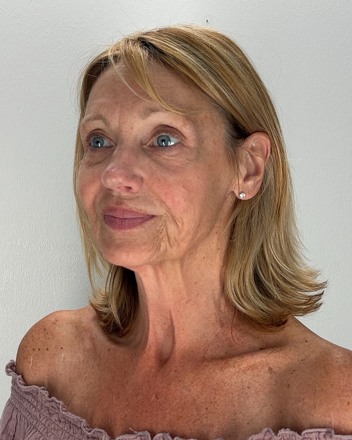 Facelift Gallery Before & After