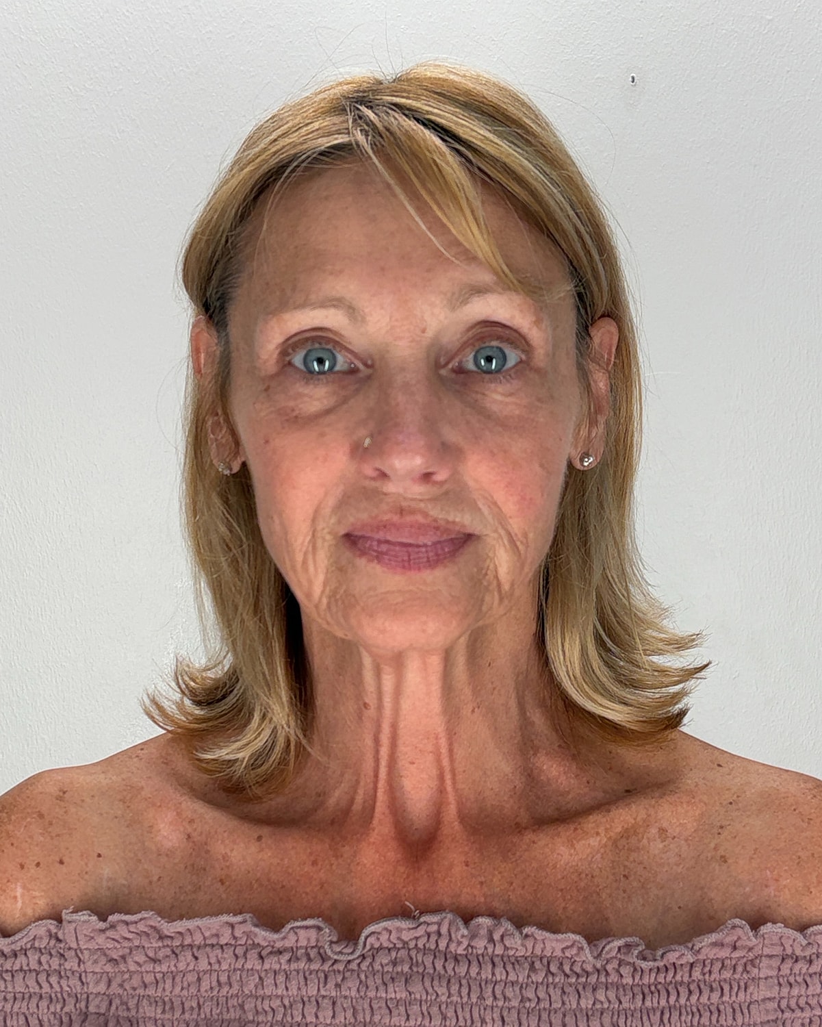Facelift Gallery Before & After