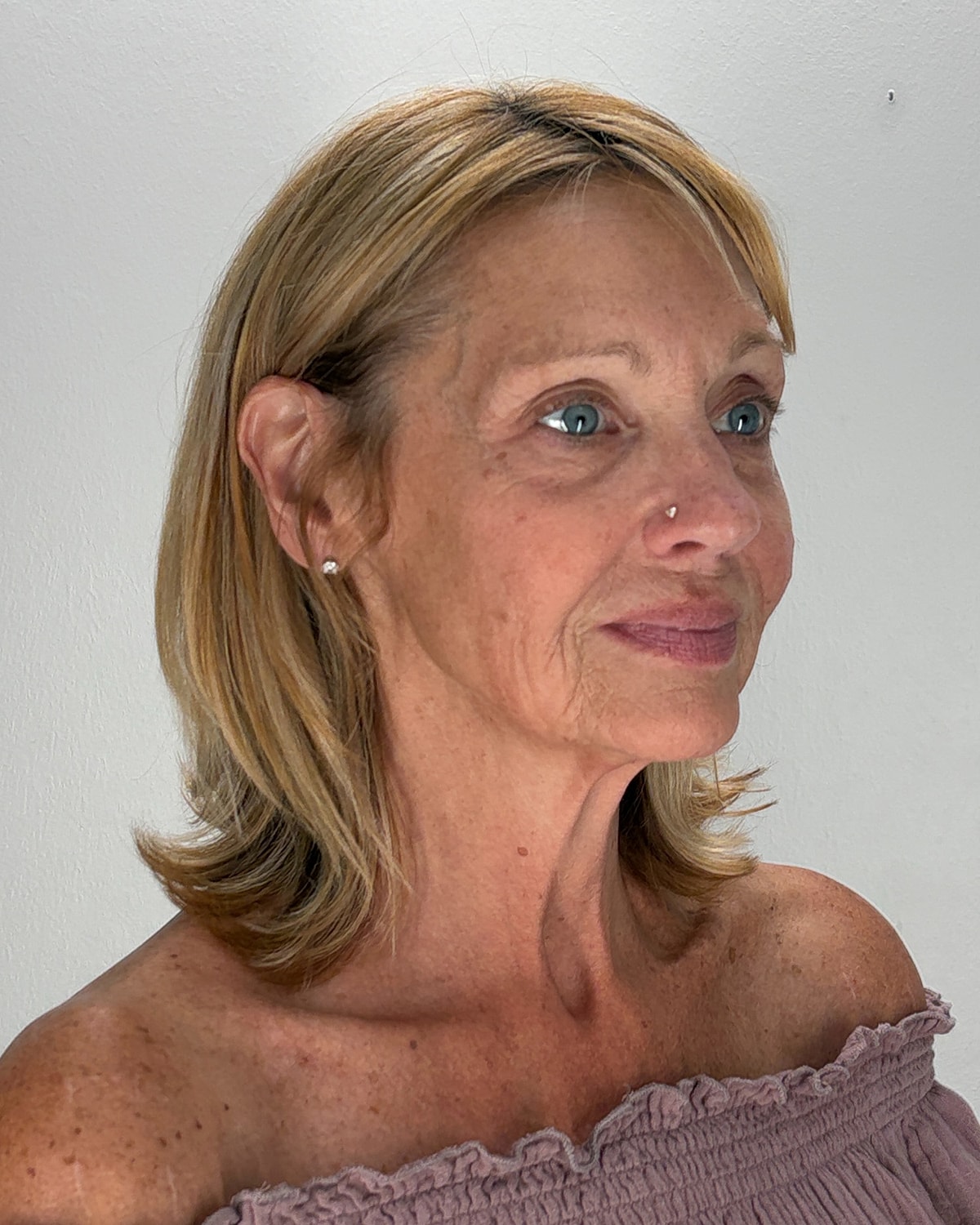 Facelift Gallery Before & After
