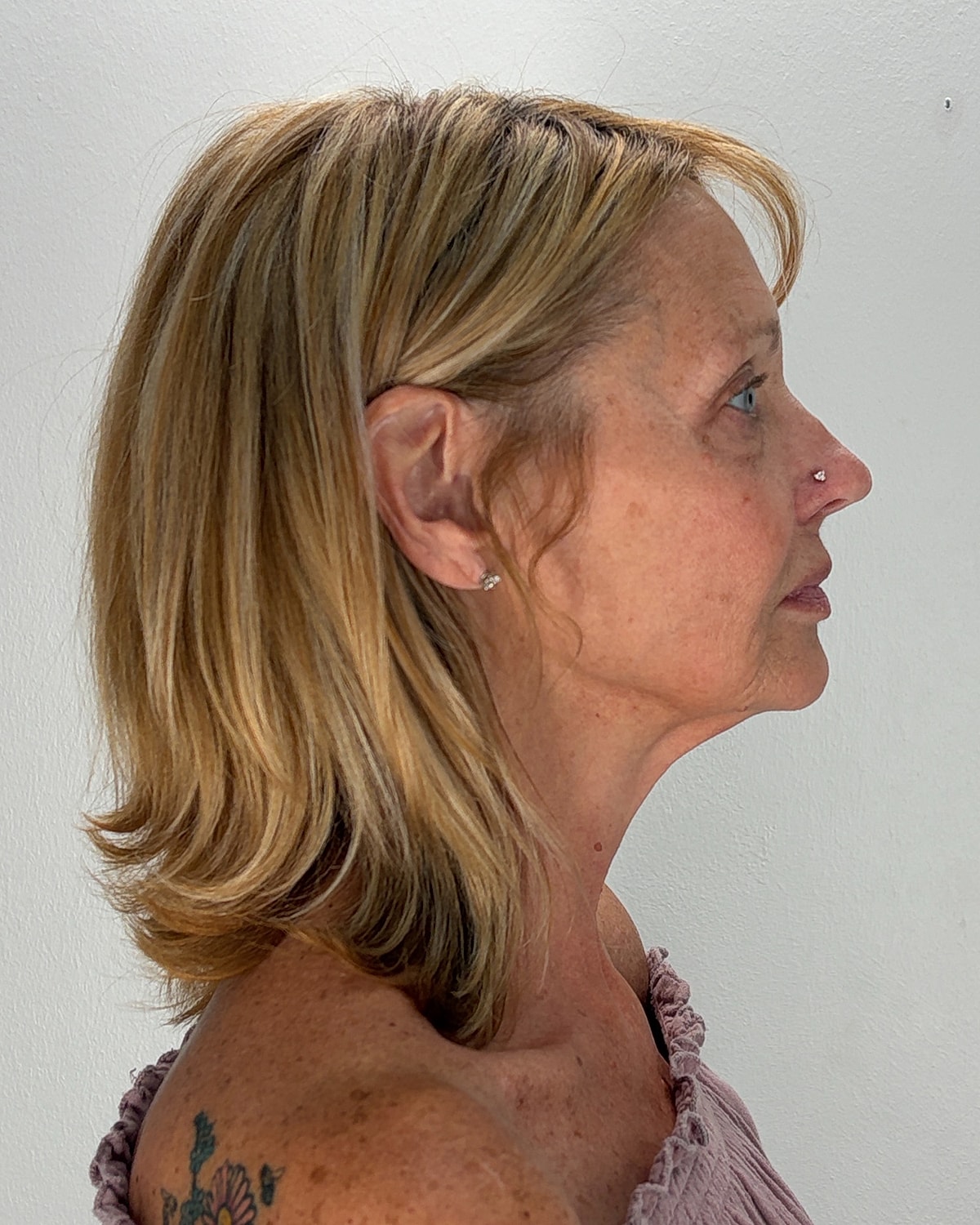 Facelift Gallery Before & After