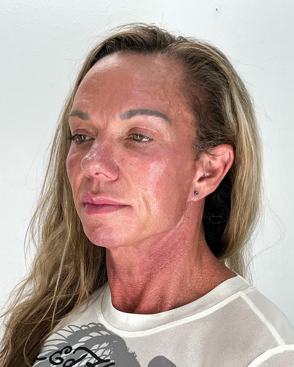 Facelift Gallery Before & After