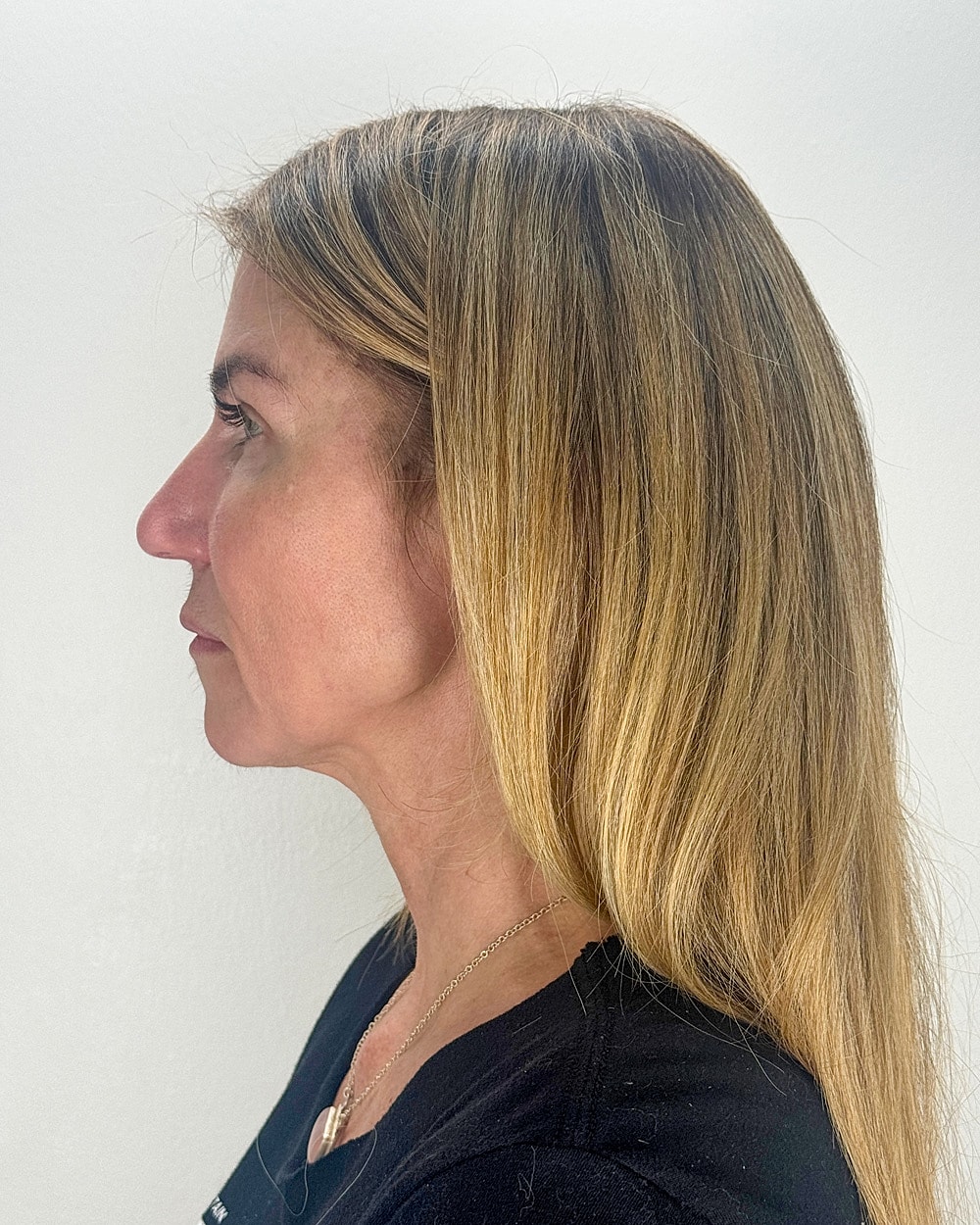 Facelift Gallery Before & After