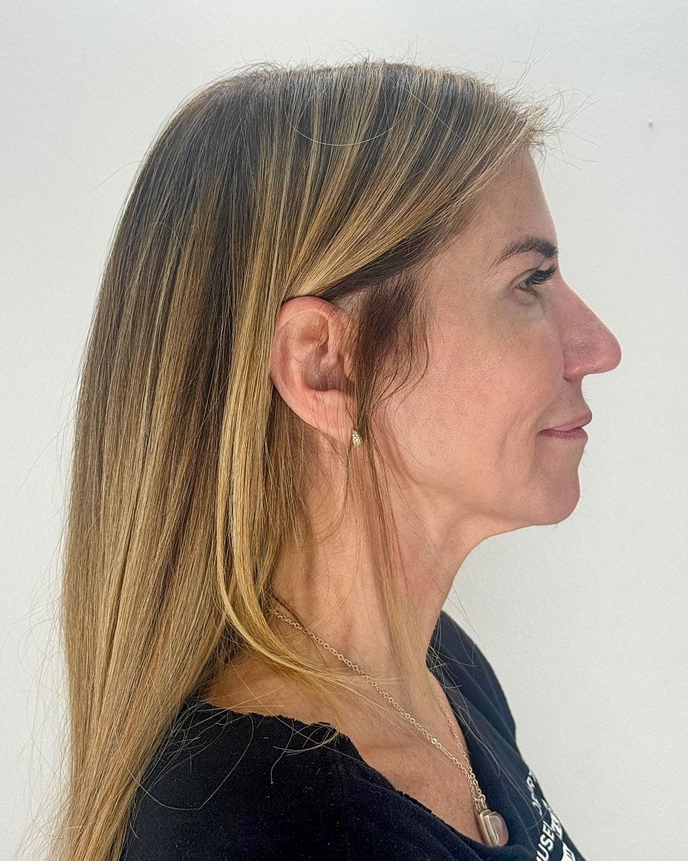 Facelift Gallery Before & After