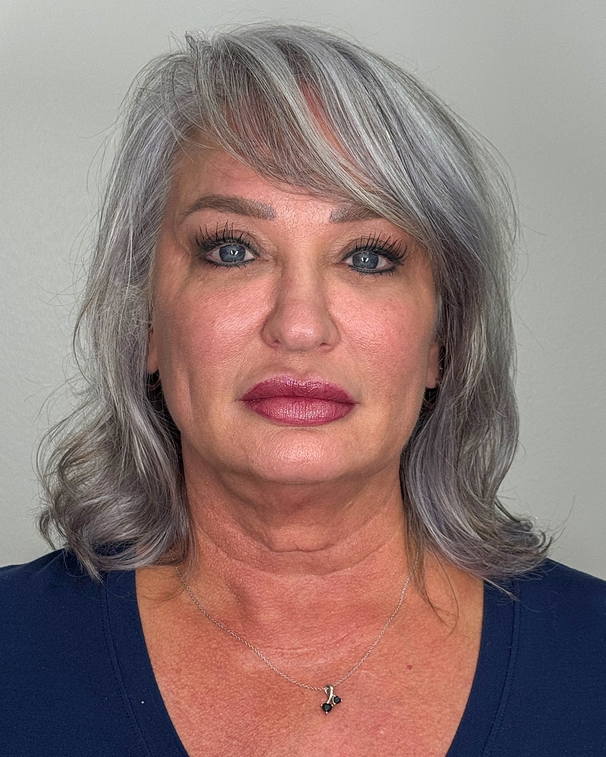 Facelift Gallery Before & After