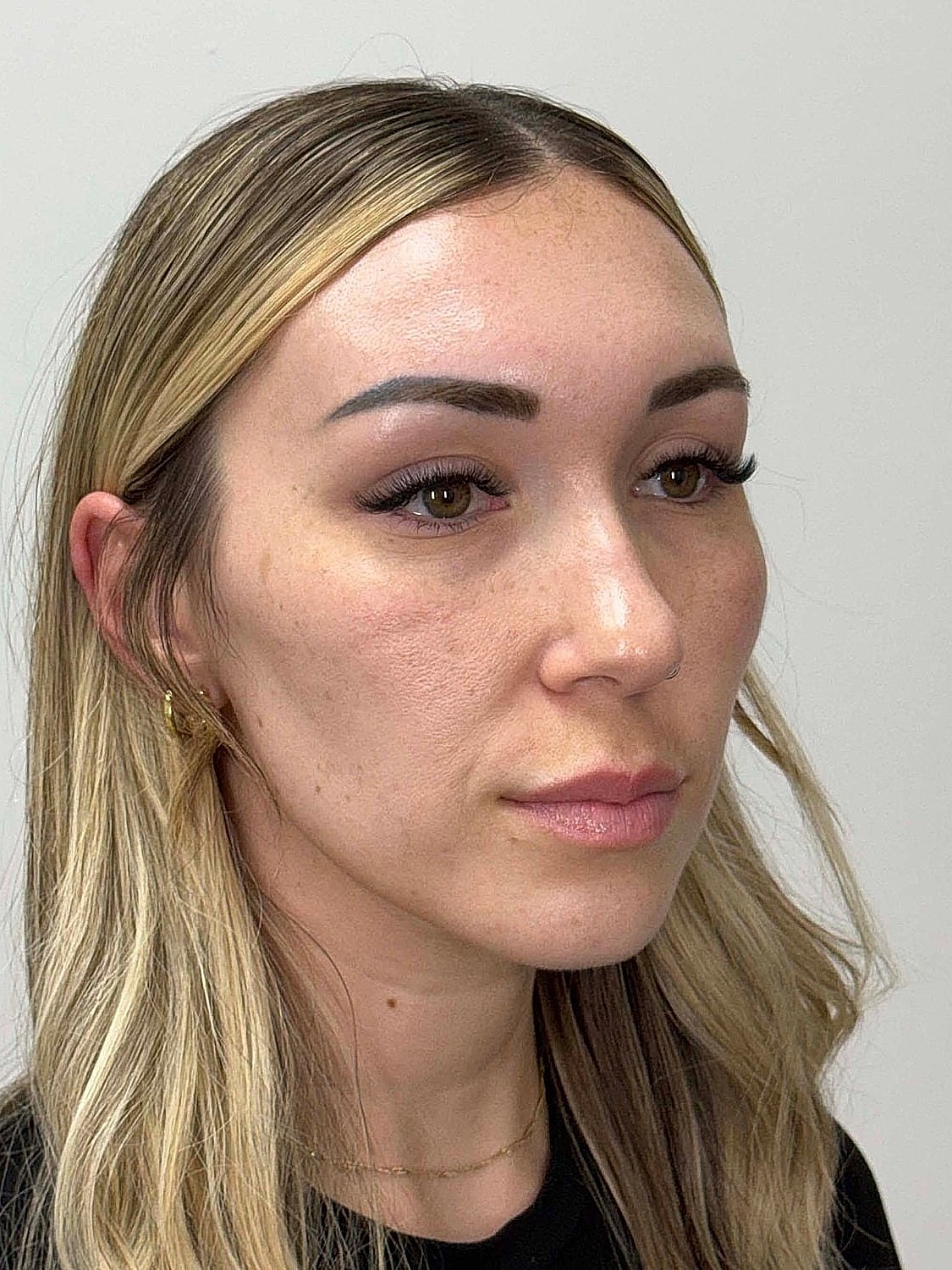 Facial Balancing Before & After