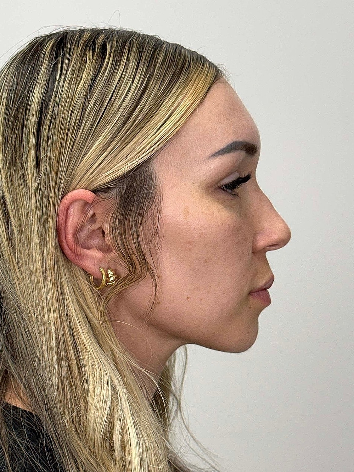 Facial Balancing Before & After