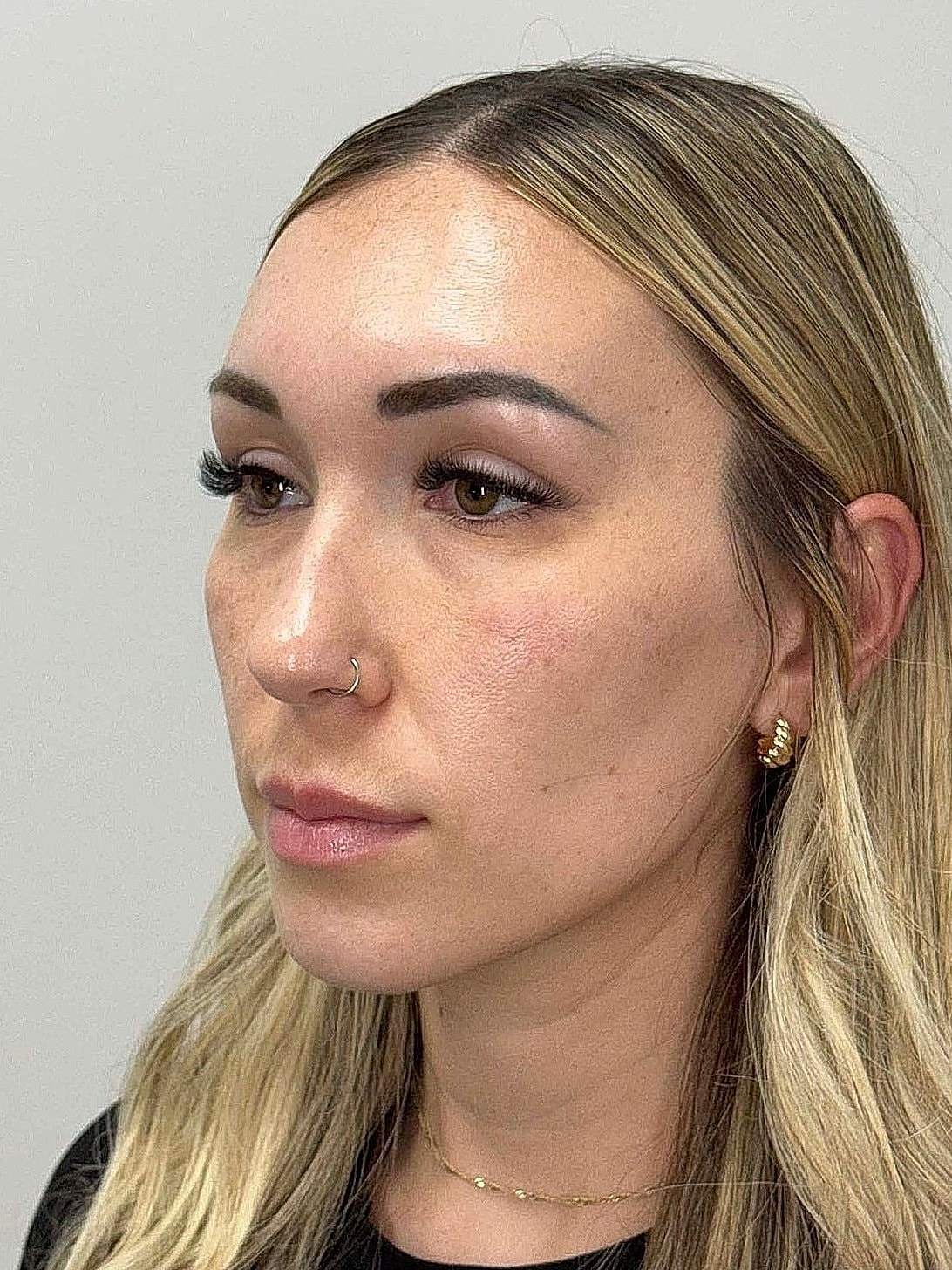 Facial Balancing Before & After