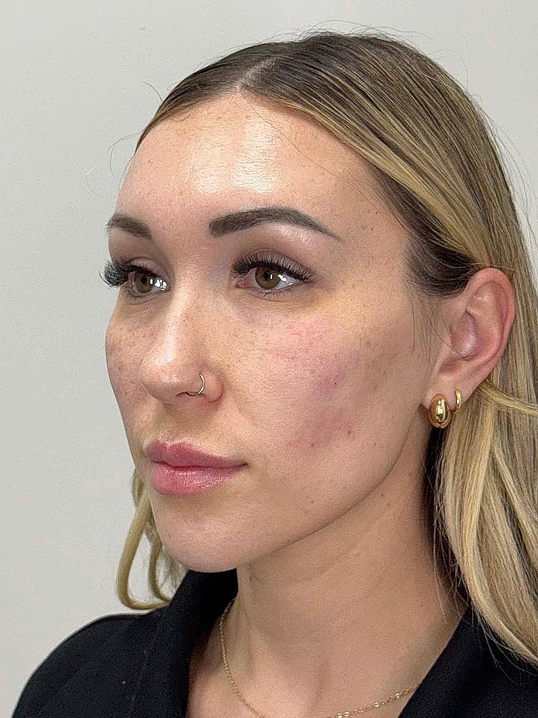 Facial Balancing Before & After