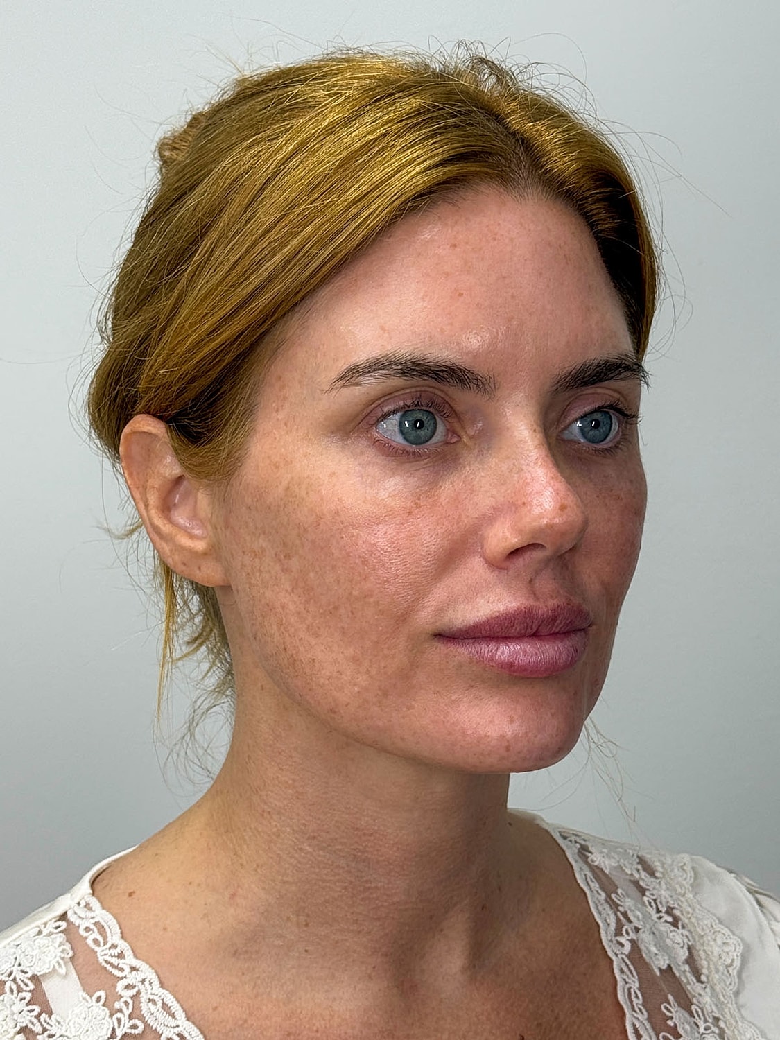 Facial Balancing Before & After