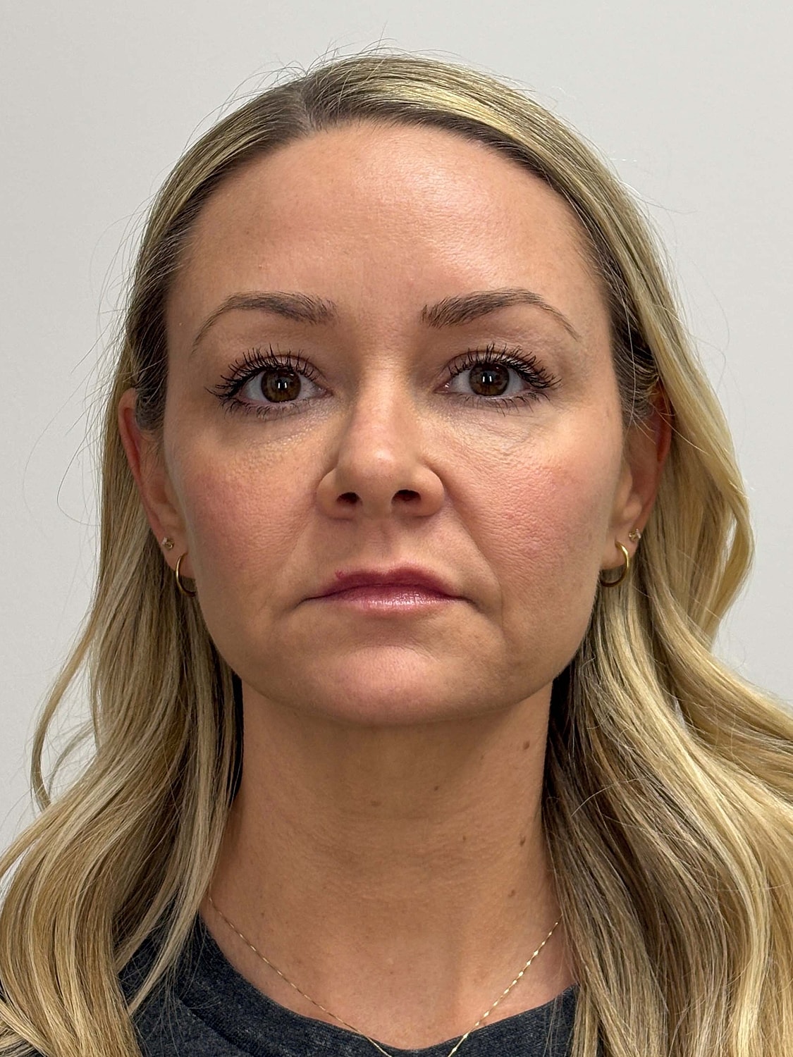 Facial Balancing Before & After
