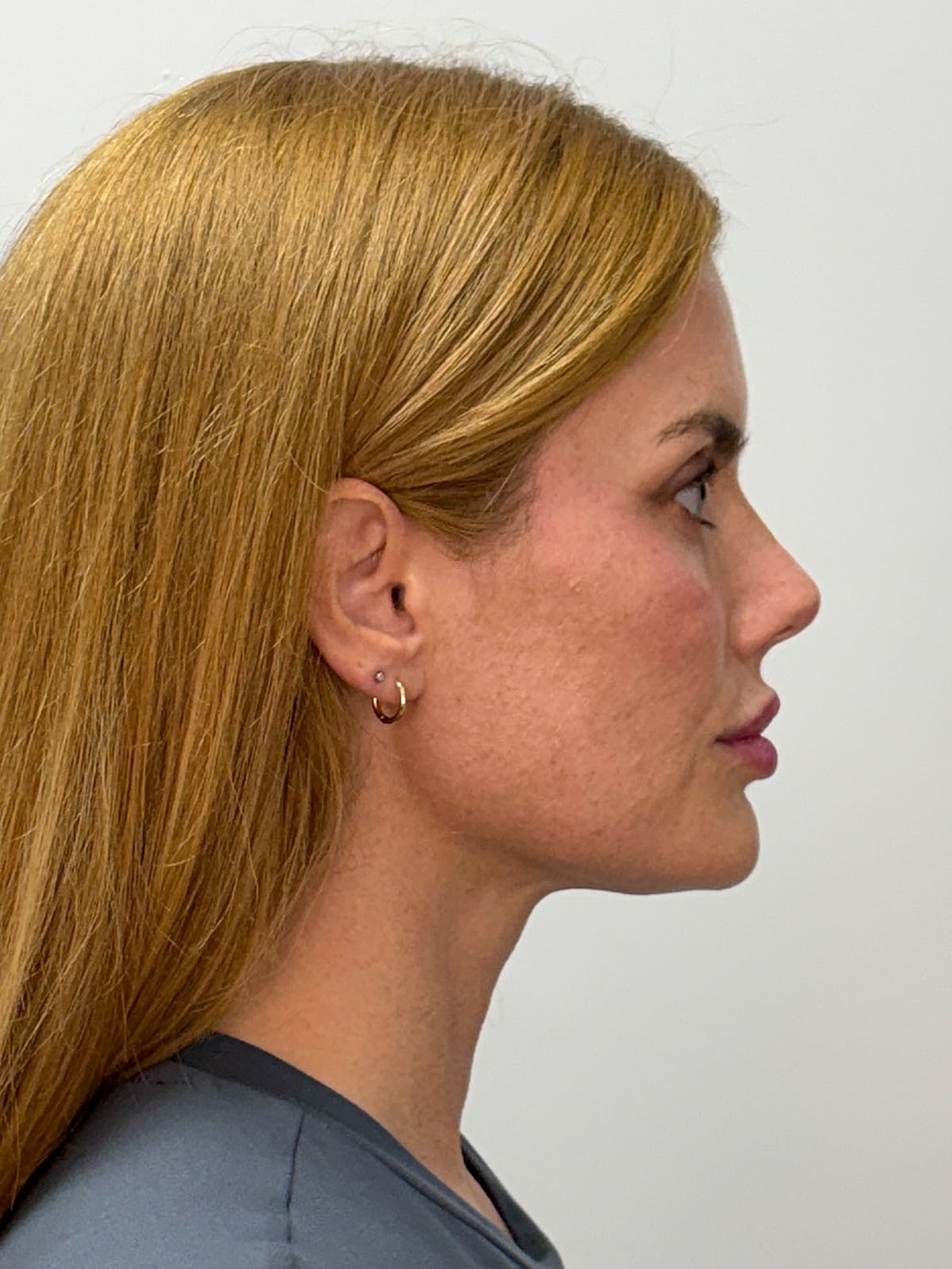 Facial Balancing Before & After