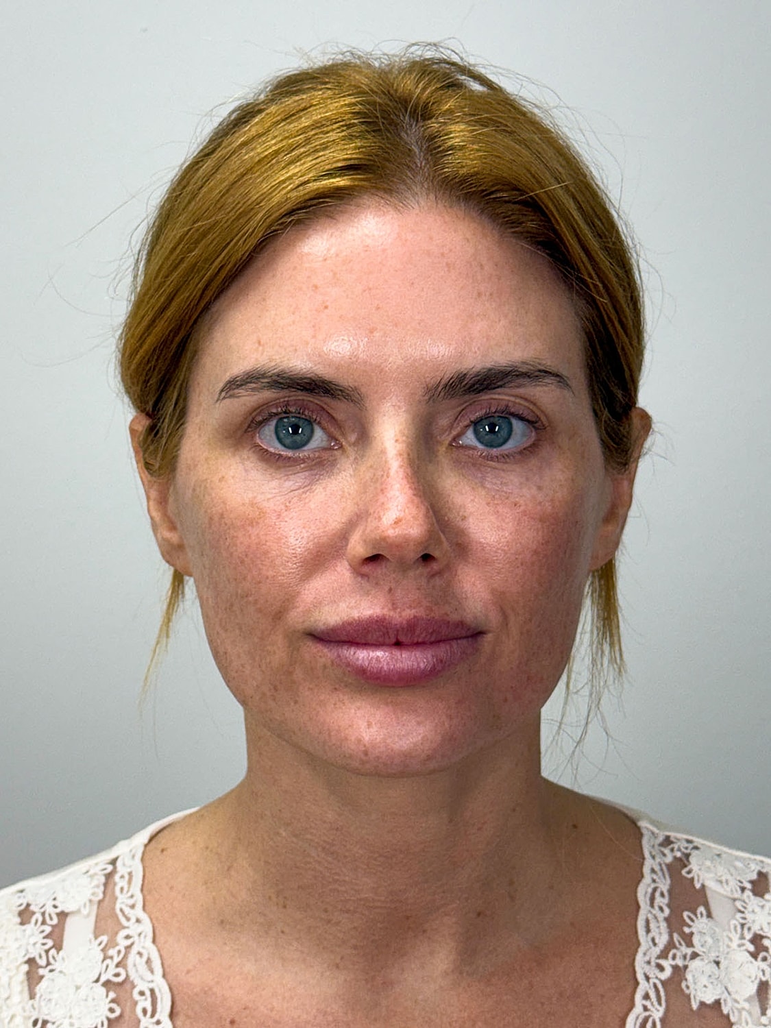 Facial Balancing Before & After