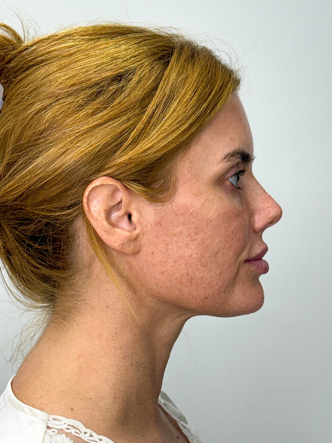 Facial Balancing Before & After