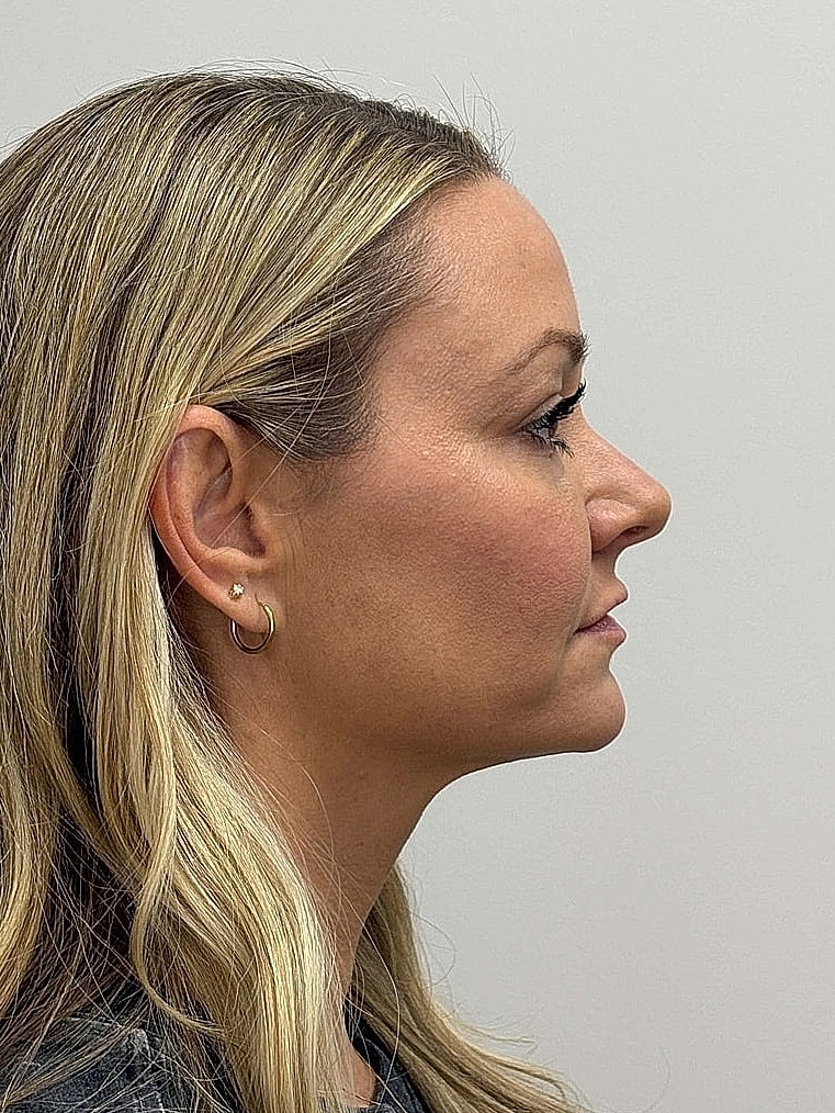 Facial Balancing Before & After