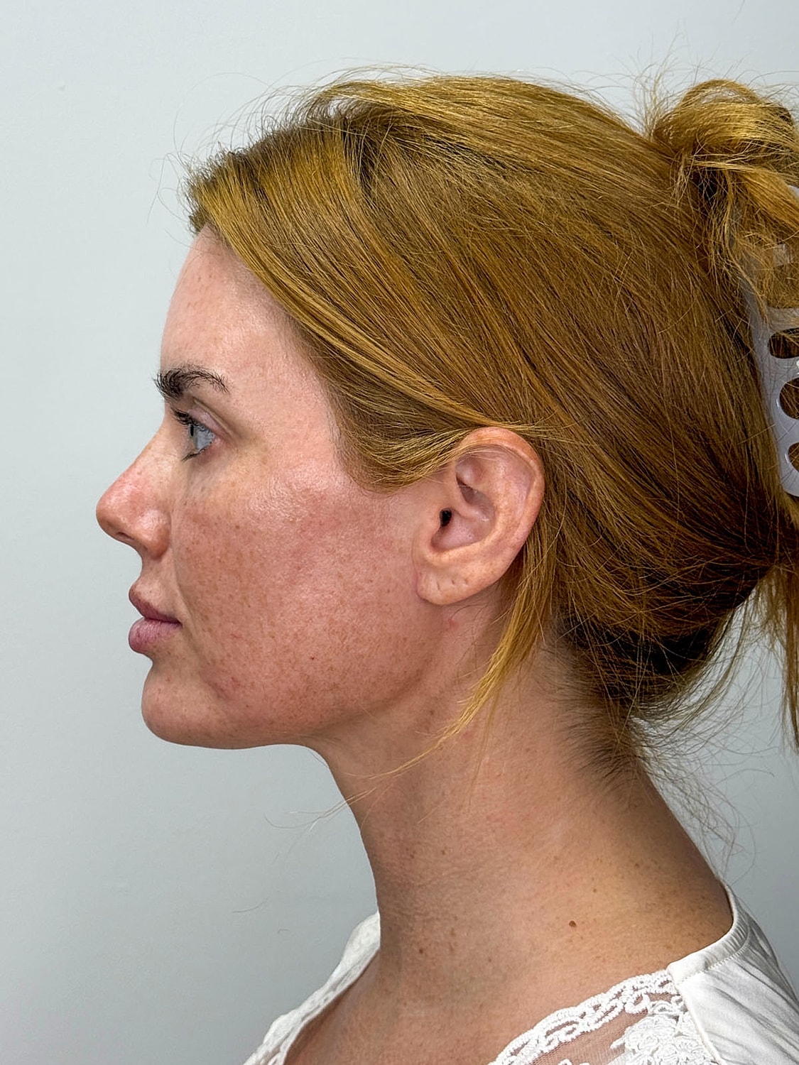 Facial Balancing Before & After