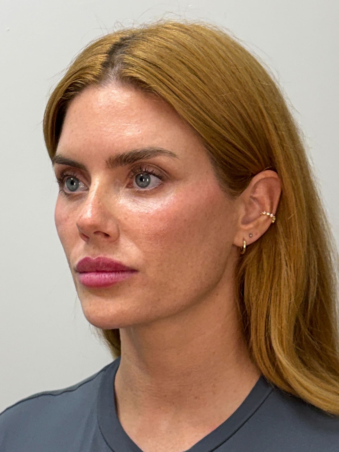 Facial Balancing Before & After