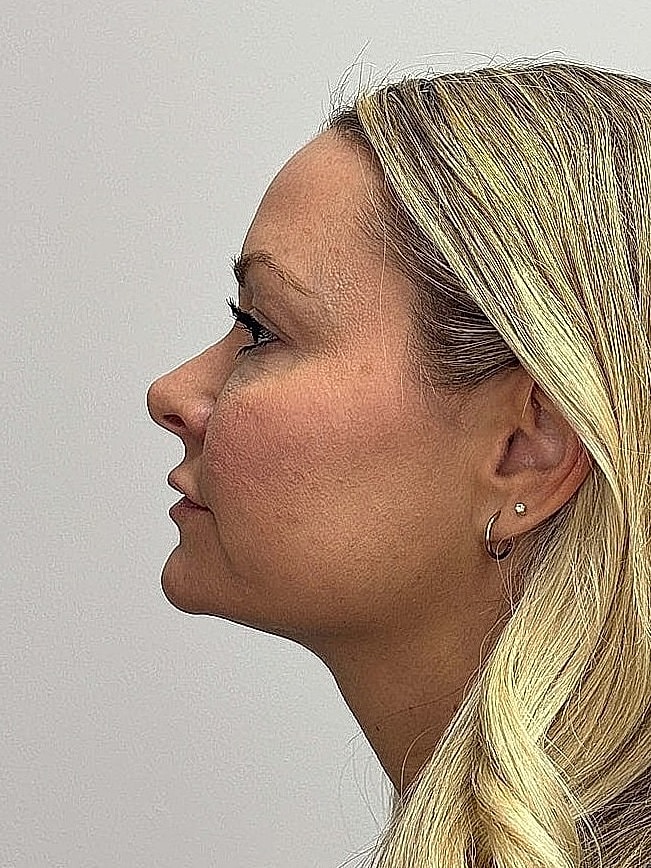 Facial Balancing Before & After