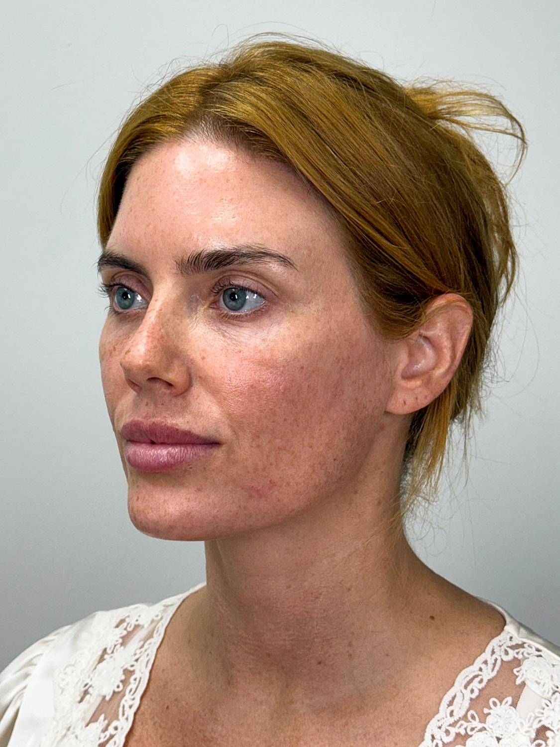 Facial Balancing Before & After