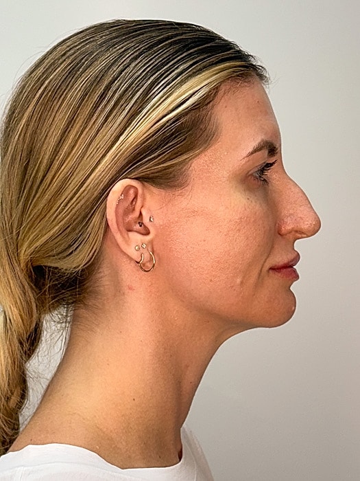 Facial Balancing Before & After