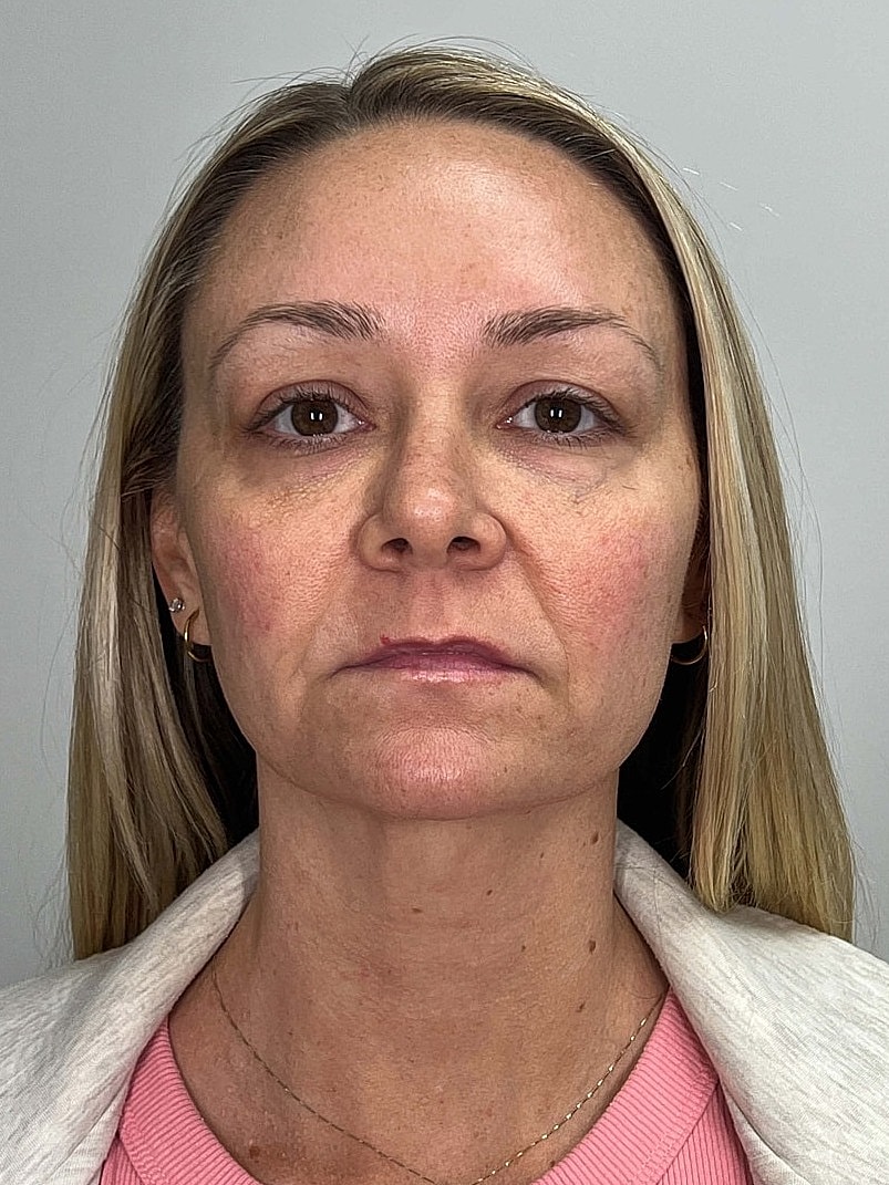 Facial Balancing Before & After