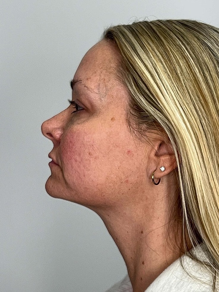 Facial Balancing Before & After