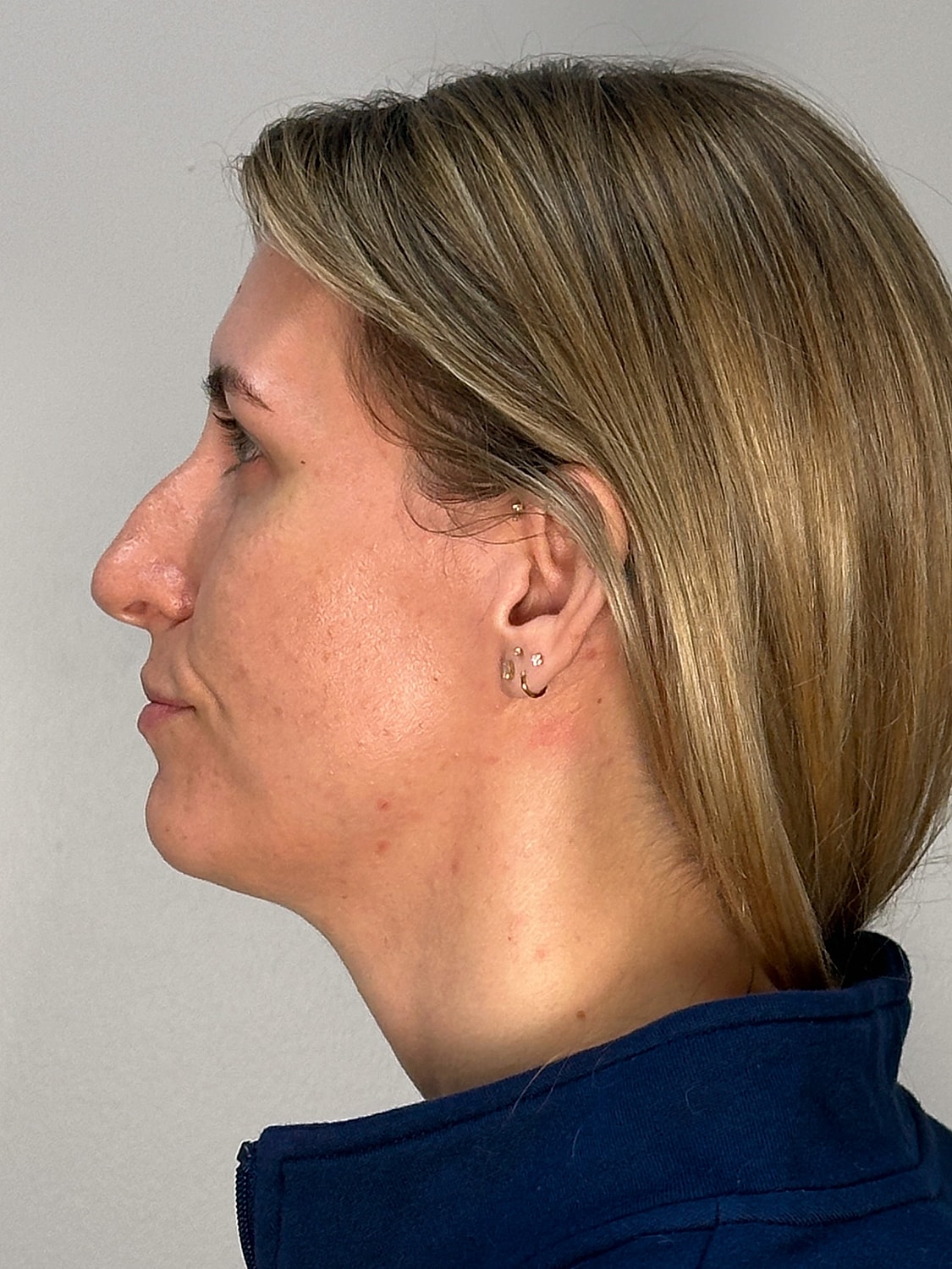 Facial Balancing Before & After