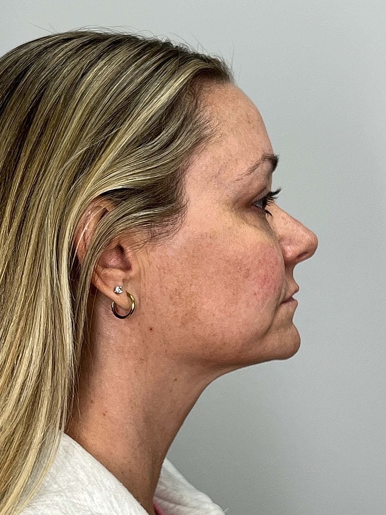 Facial Balancing Before & After
