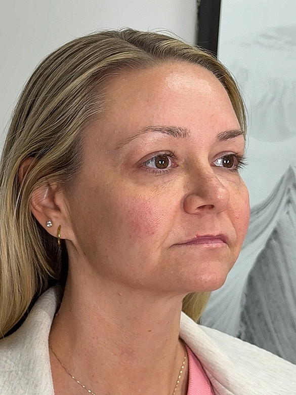 Facial Balancing Before & After