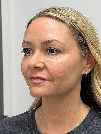 Facial Balancing Before & After