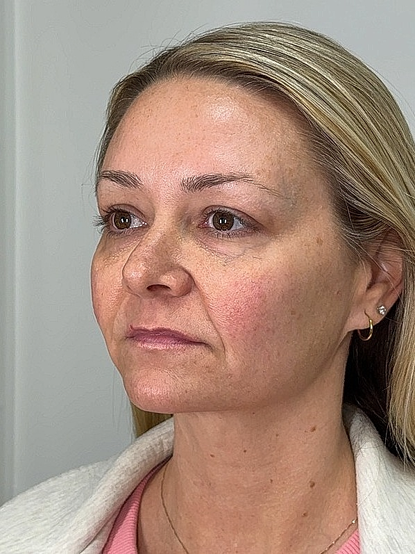 Facial Balancing Before & After