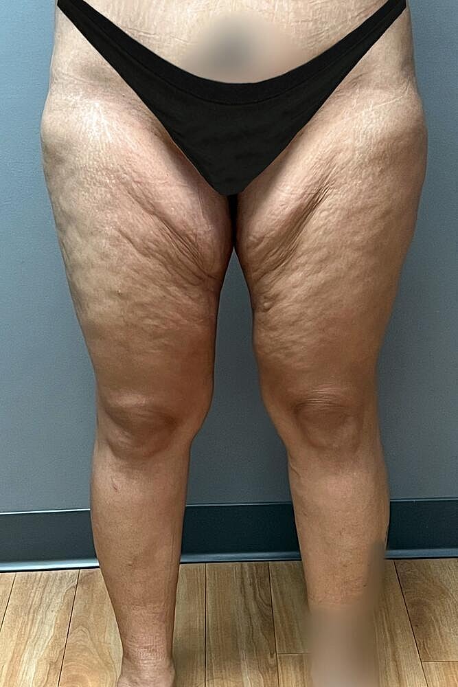 Thigh Lift Before & After