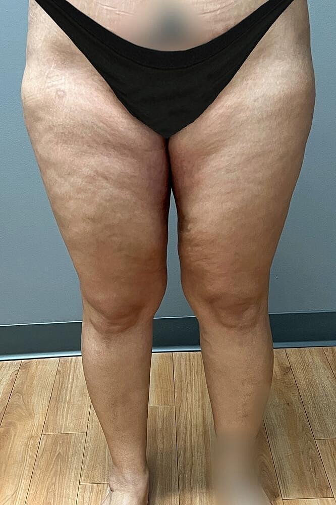 Thigh Lift Before & After