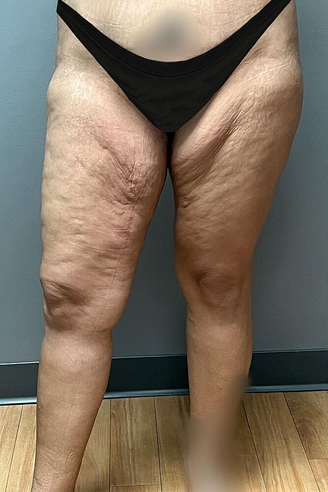 Thigh Lift Before & After