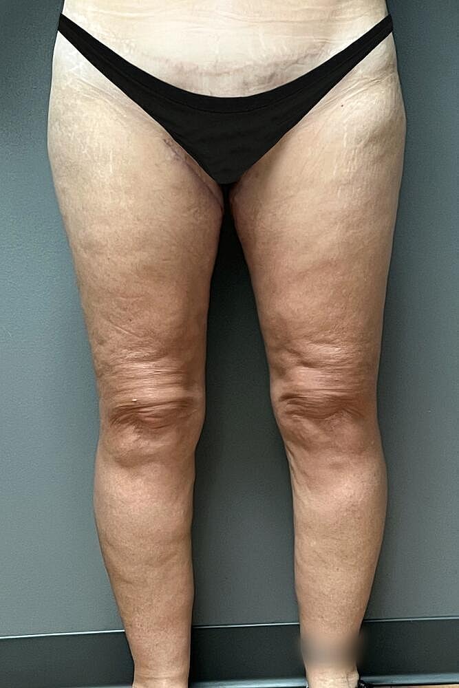 Thigh Lift Before & After