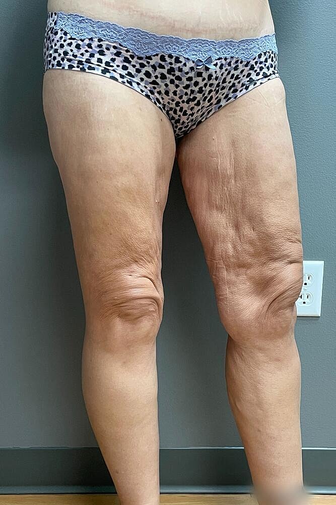 Thigh Lift Before & After
