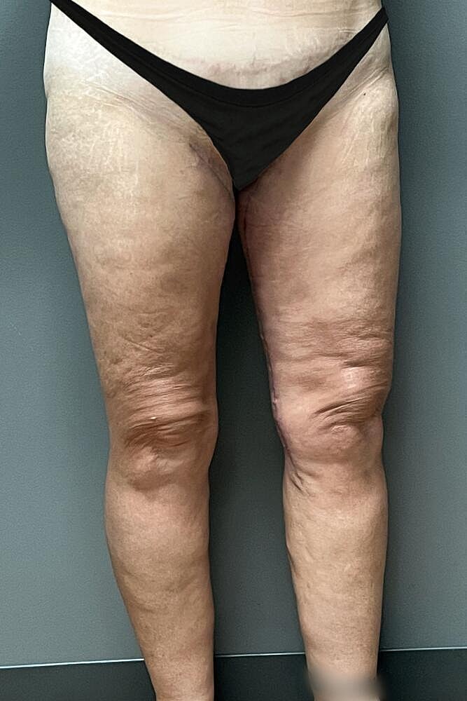 Thigh Lift Before & After