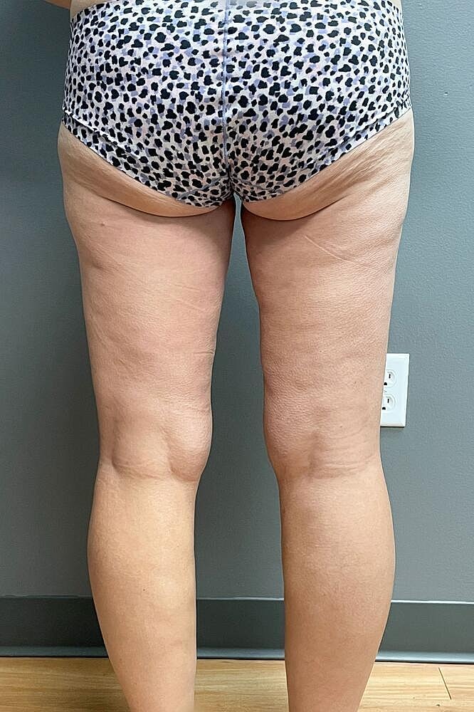 Thigh Lift Before & After