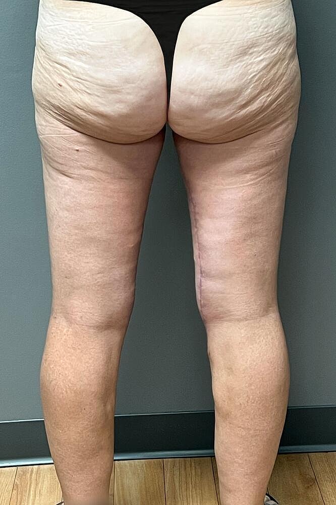Thigh Lift Before & After
