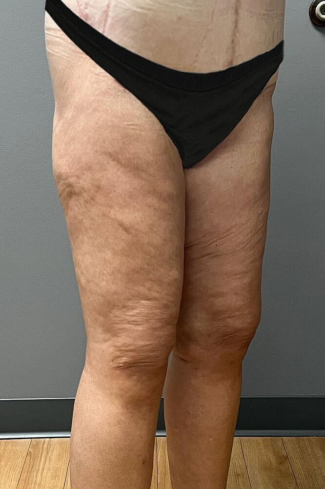 Thigh Lift Before & After