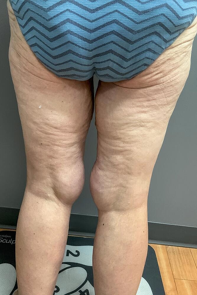 Thigh Lift Before & After