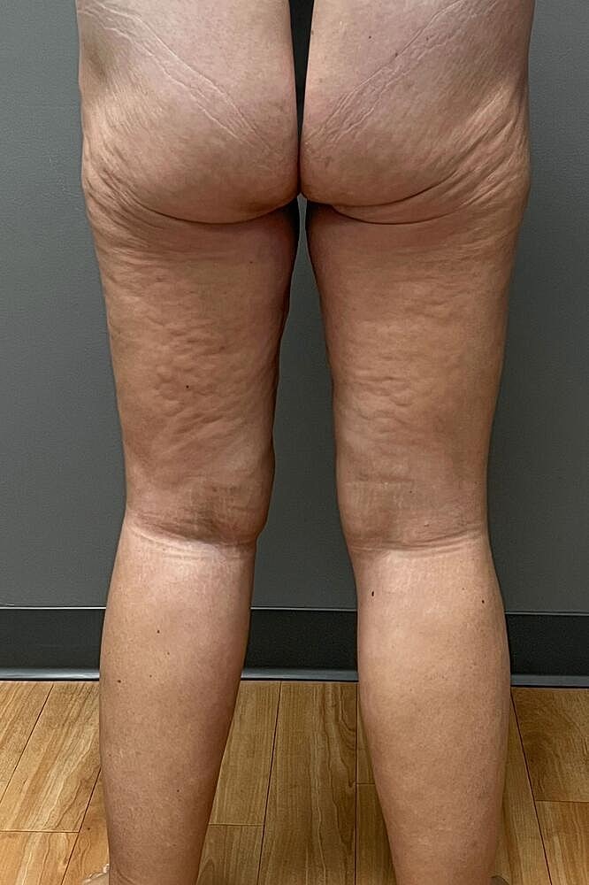 Thigh Lift Before & After
